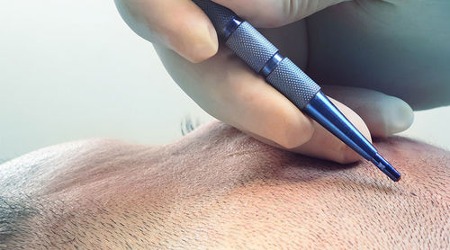 Последние новости компании о Использование сапфировых лезвий при операции по трансплантации волос